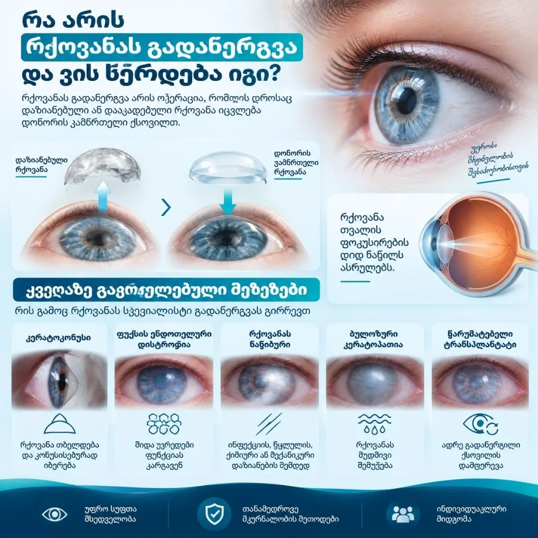 კერატოკონუსის მკურნალობა